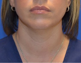 Kybella