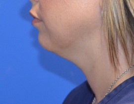 Kybella