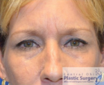 Blepharoplasty