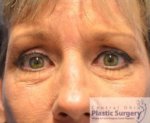 Blepharoplasty