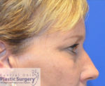 Blepharoplasty