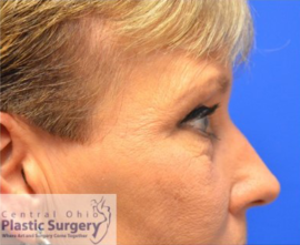 Blepharoplasty