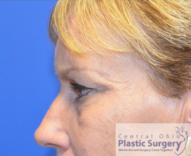 Blepharoplasty