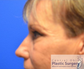 Blepharoplasty