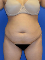 Tummy Tuck