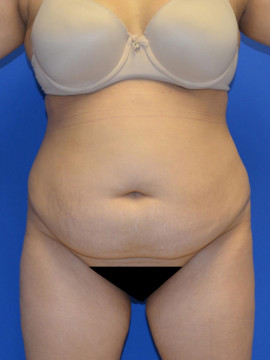 Tummy Tuck