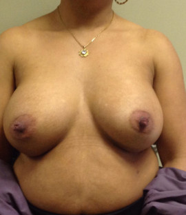 Breast Augmentation