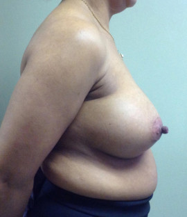 Breast Augmentation