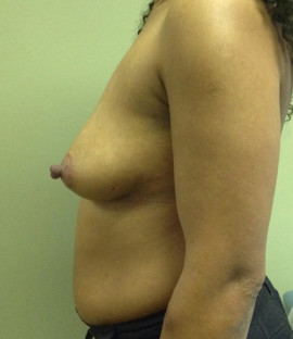 Breast Augmentation