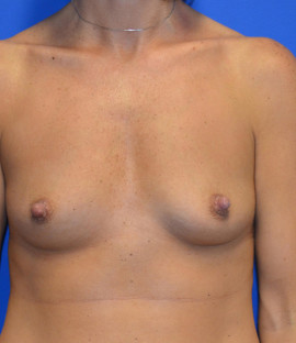 Breast Augmentation