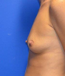 Breast Augmentation