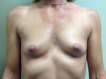 Breast Augmentation