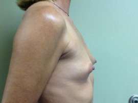 Breast Augmentation