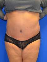 Tummy Tuck