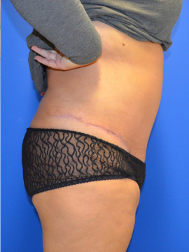 Tummy Tuck