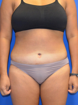 Tummy Tuck