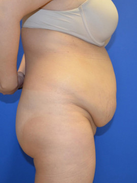 Tummy Tuck