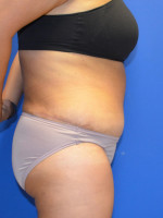 Tummy Tuck