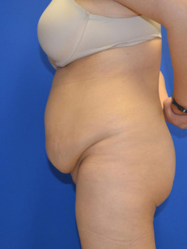 Tummy Tuck