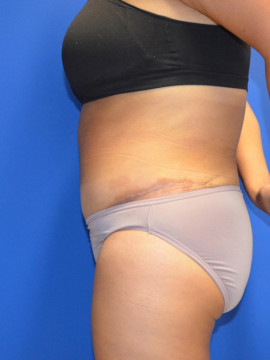 Tummy Tuck