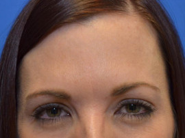 Injectable Fillers/Botox