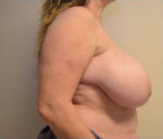 Breast Reduction/Breast Lift