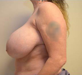 Breast Reduction/Breast Lift