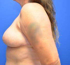Breast Reduction/Breast Lift
