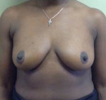 Breast Augmentation