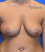 Breast Augmentation