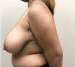 Breast Reduction/Breast Lift