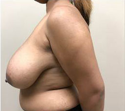 Breast Reduction/Breast Lift