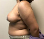 Breast Reduction/Breast Lift