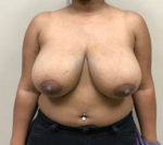 Breast Reduction/Breast Lift