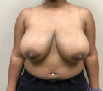 Breast Lift