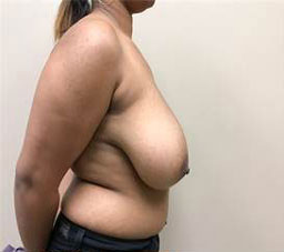 Breast Reduction/Breast Lift