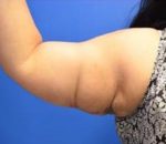 Arm Lift