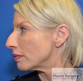 Injectable Fillers/Botox