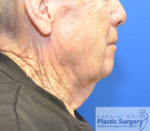 Facelift & Necklift