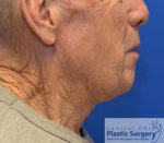 Facelift & Necklift