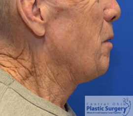 Facelift & Necklift