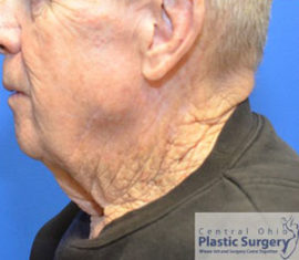 Facelift & Necklift