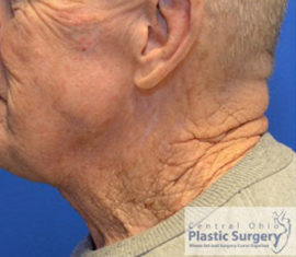 Facelift & Necklift