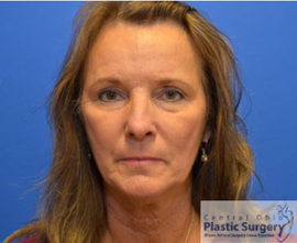 Facelift & Necklift