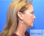 Facelift & Necklift