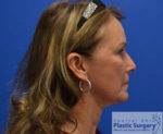 Facelift & Necklift