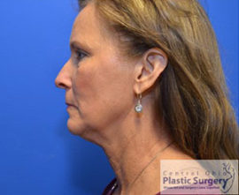 Facelift & Necklift