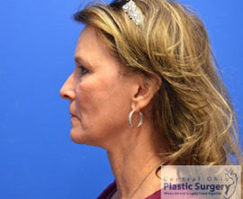 Facelift & Necklift