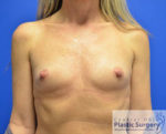 Breast Augmentation