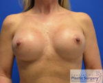 Breast Augmentation